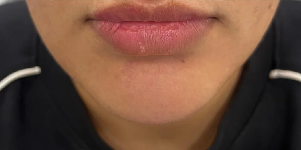 Lip and chin refinement result — after