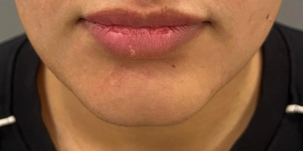 Lip and chin refinement result — before