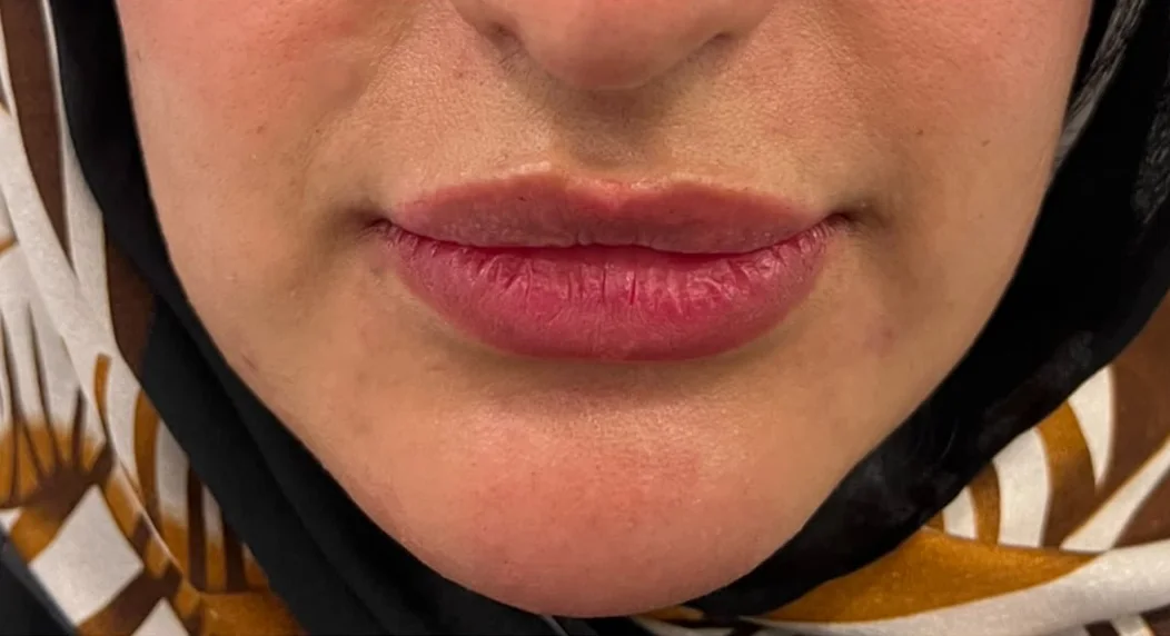 Lip treatment result, front view — after