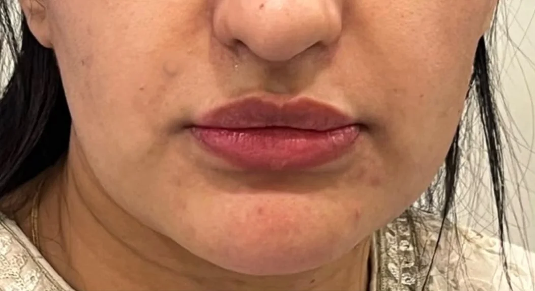 Lip treatment result, front view — before