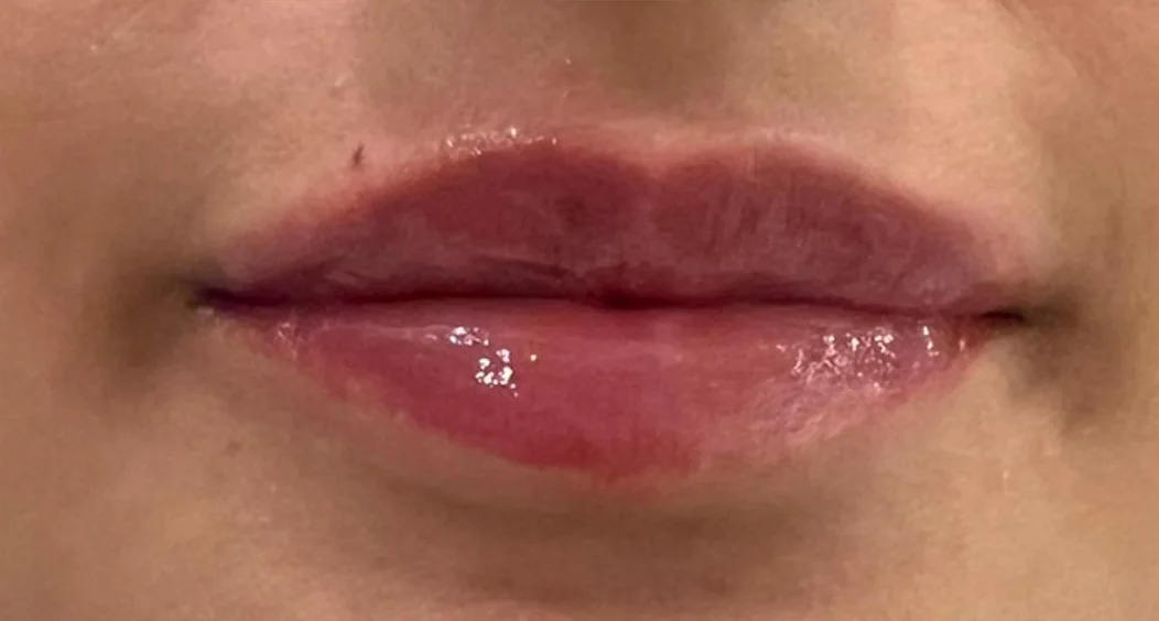 Lip treatment result — after
