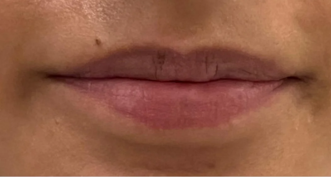 Lip treatment result — before