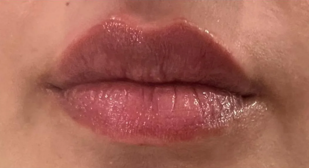 Lip treatment result, close view — after
