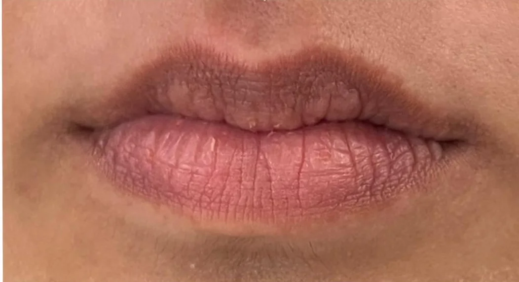 Lip treatment result, close view — before